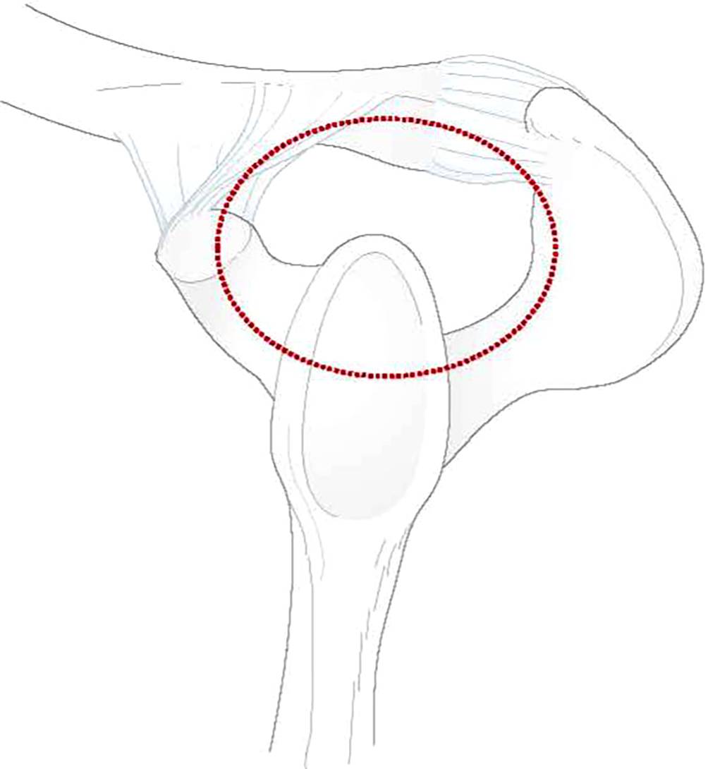 Update Skapulafrakturen