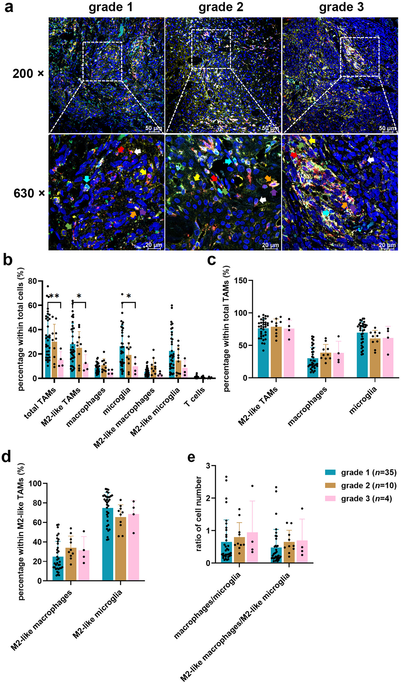 Tumour-associated macrophage infiltration differs in meningioma genotypes, and is important in tumour dynamics