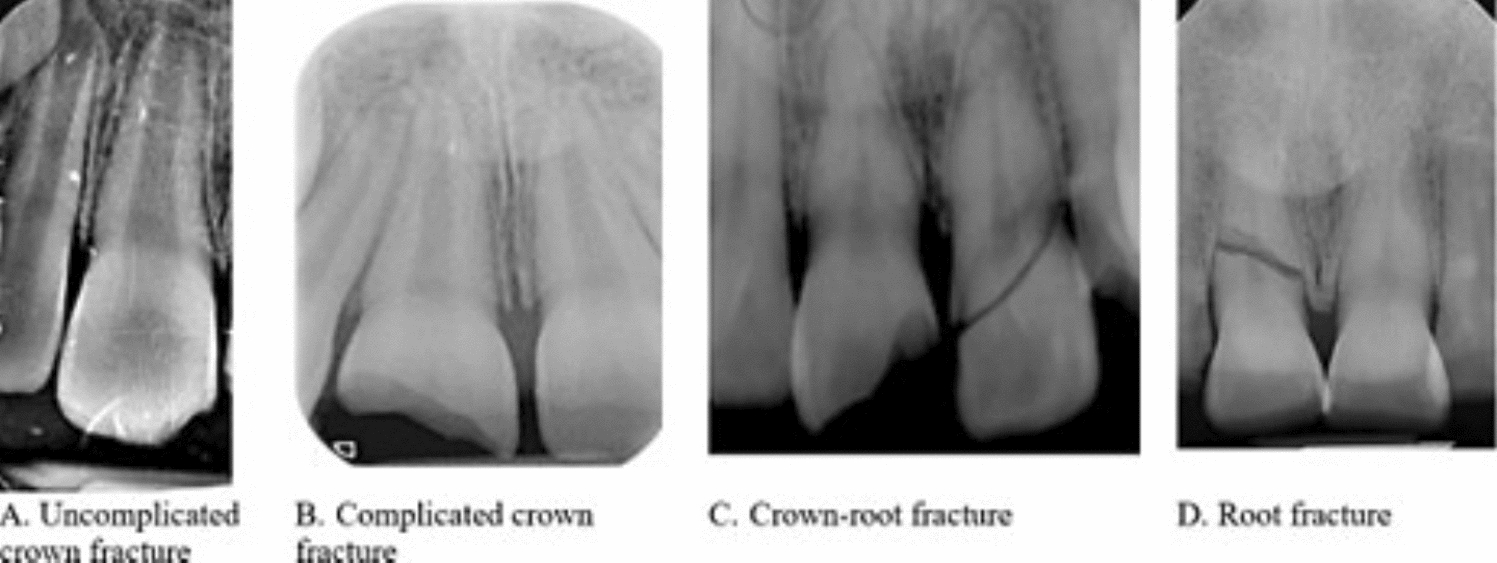 Artificial intelligence model for application in dental traumatology