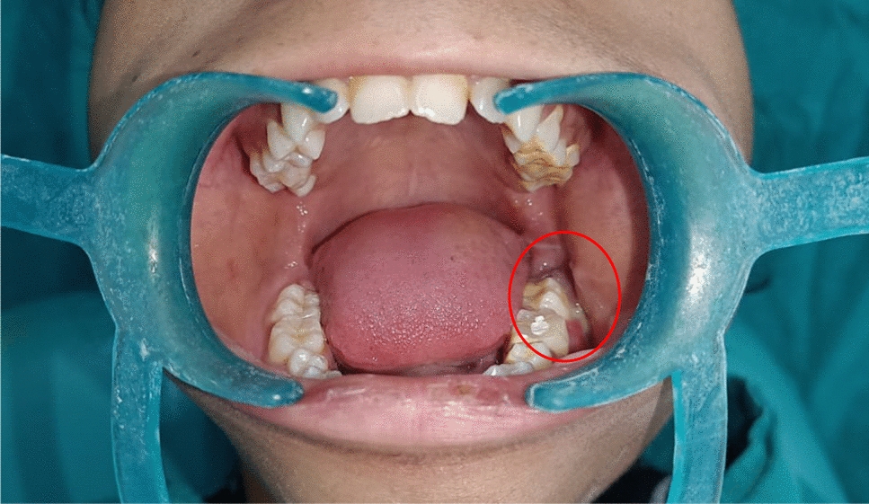 The Masquerading Infection: Tuberculosis Presenting as Mandibular Osteomyelitis