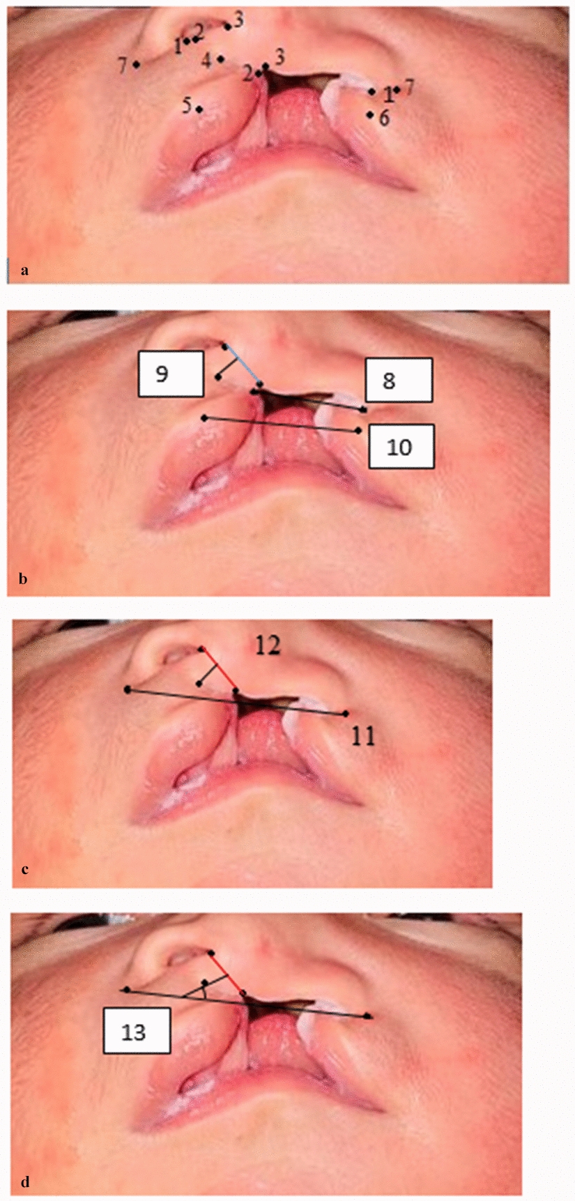 Assessment of Lip Taping in Changing Maxillofacial Soft and Hard Tissue Dimensions in Cleft Patients: A Retrospective Cohort Study