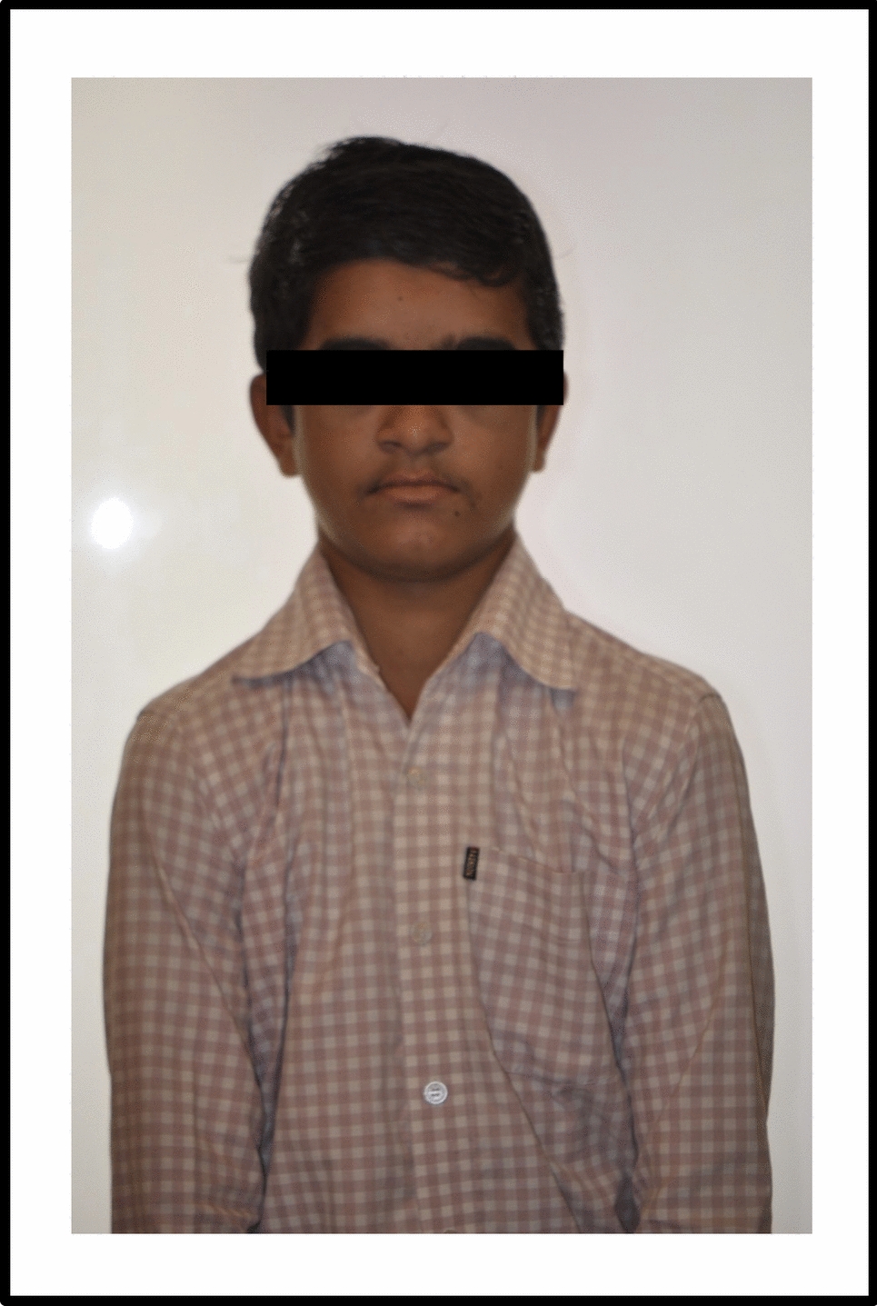 Orthodontic and Surgical Management of Patient with Cleidocranial Dysplasia having Multiple Impacted and Supernumerary Teeth: A Rare Case Report