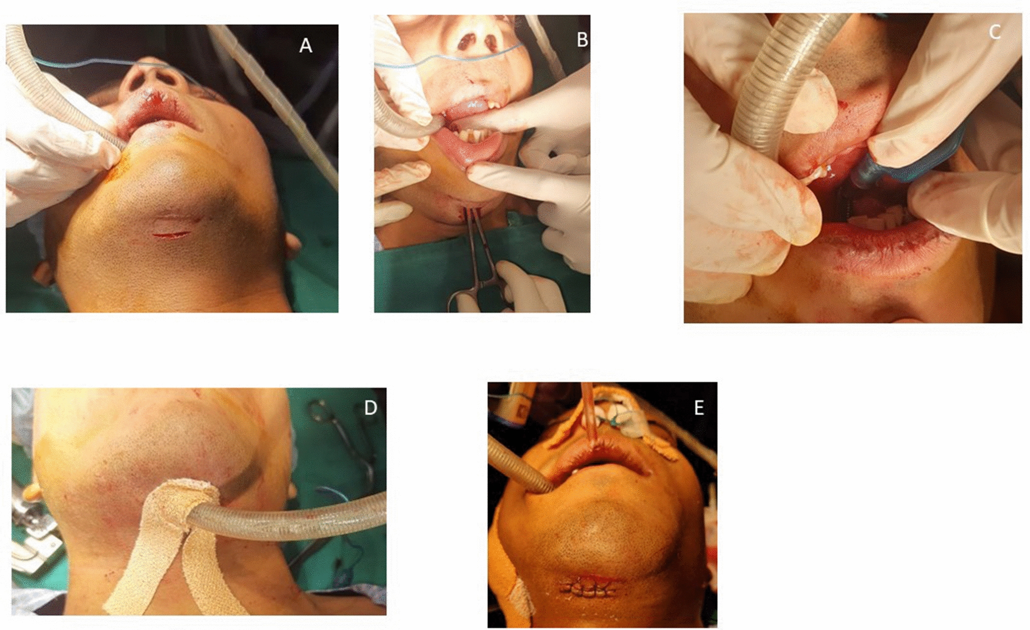 Transmylohyoid Intubation in Panfacial Trauma Patients: A 10-Years Retrospective Study