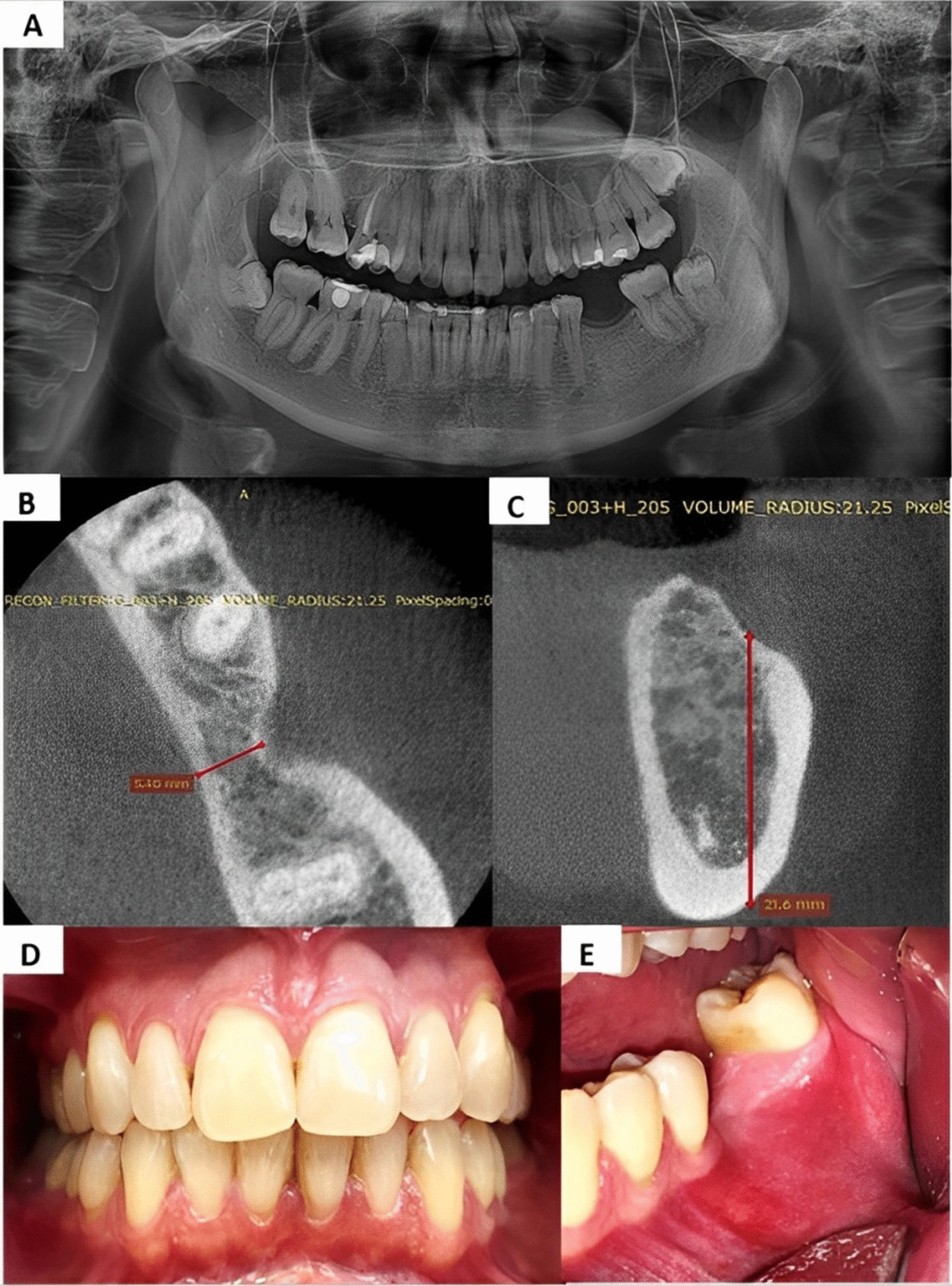 Clinical and Tomographic Evaluation of Autogenous Dentin and Cementum Graft from Root Remnants: Clinical Case Report