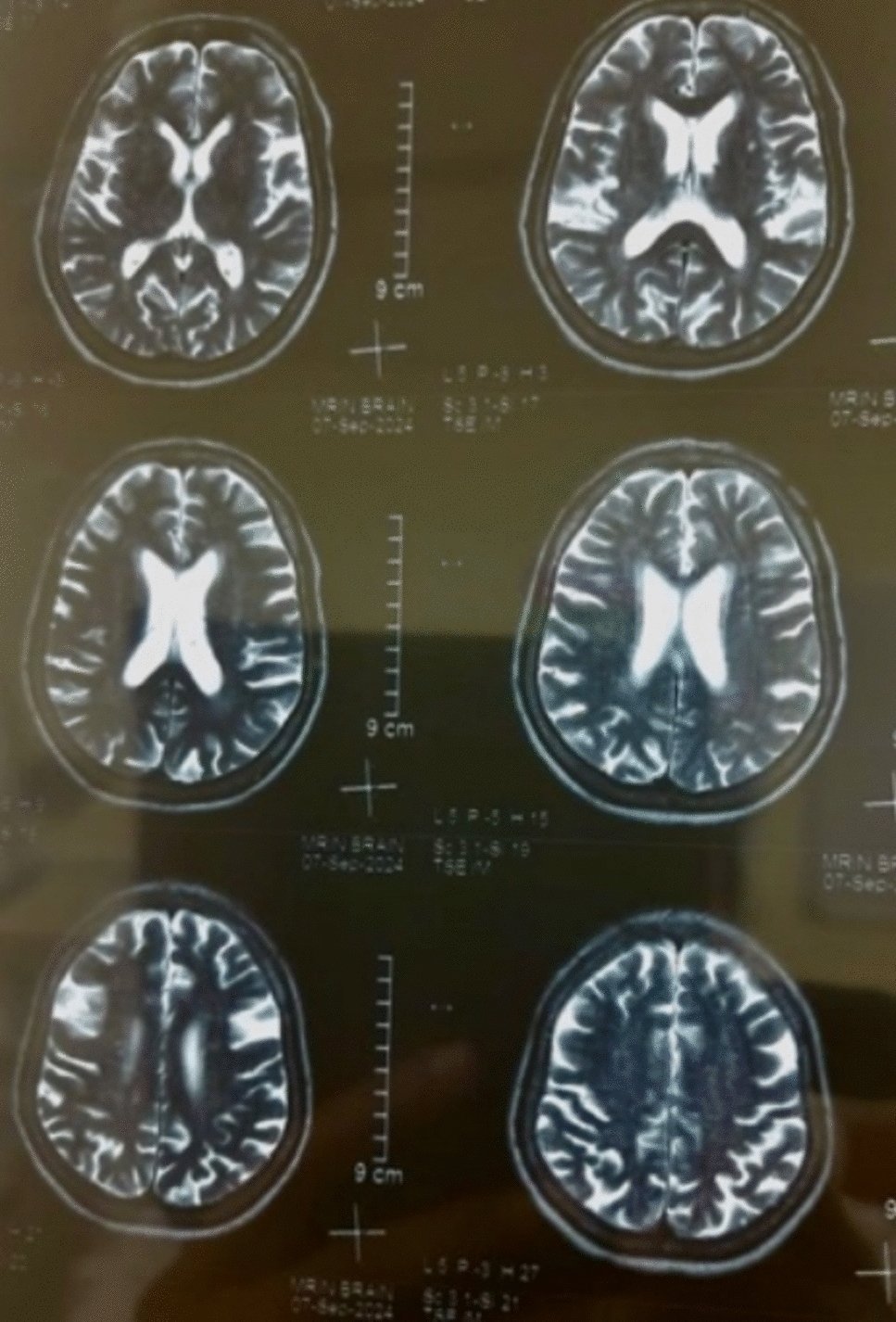 Long-Term Pharmaco-Surgical Management and Review of Recurrent Atypical Spreading Long Buccal and Lingual Nerve Trigeminal Neuralgia