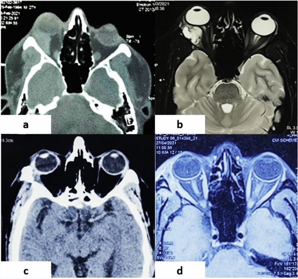Versatility of Lateral Orbitotomy Approach for Intra-orbital Lesions—A Retrospective Study
