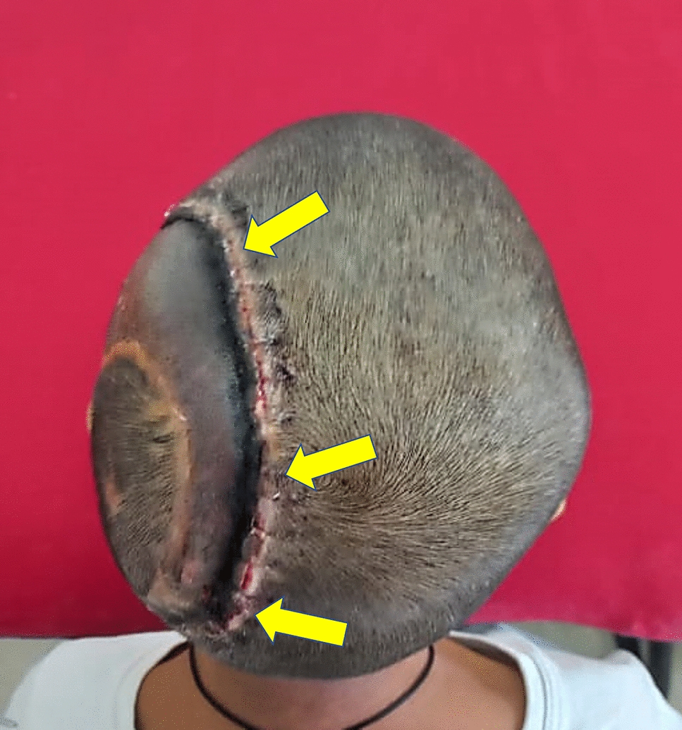Addressing Complications in Titanium Mesh Cranioplasty: The Role of Temporo-parieto-occipital Flap Reconstruction