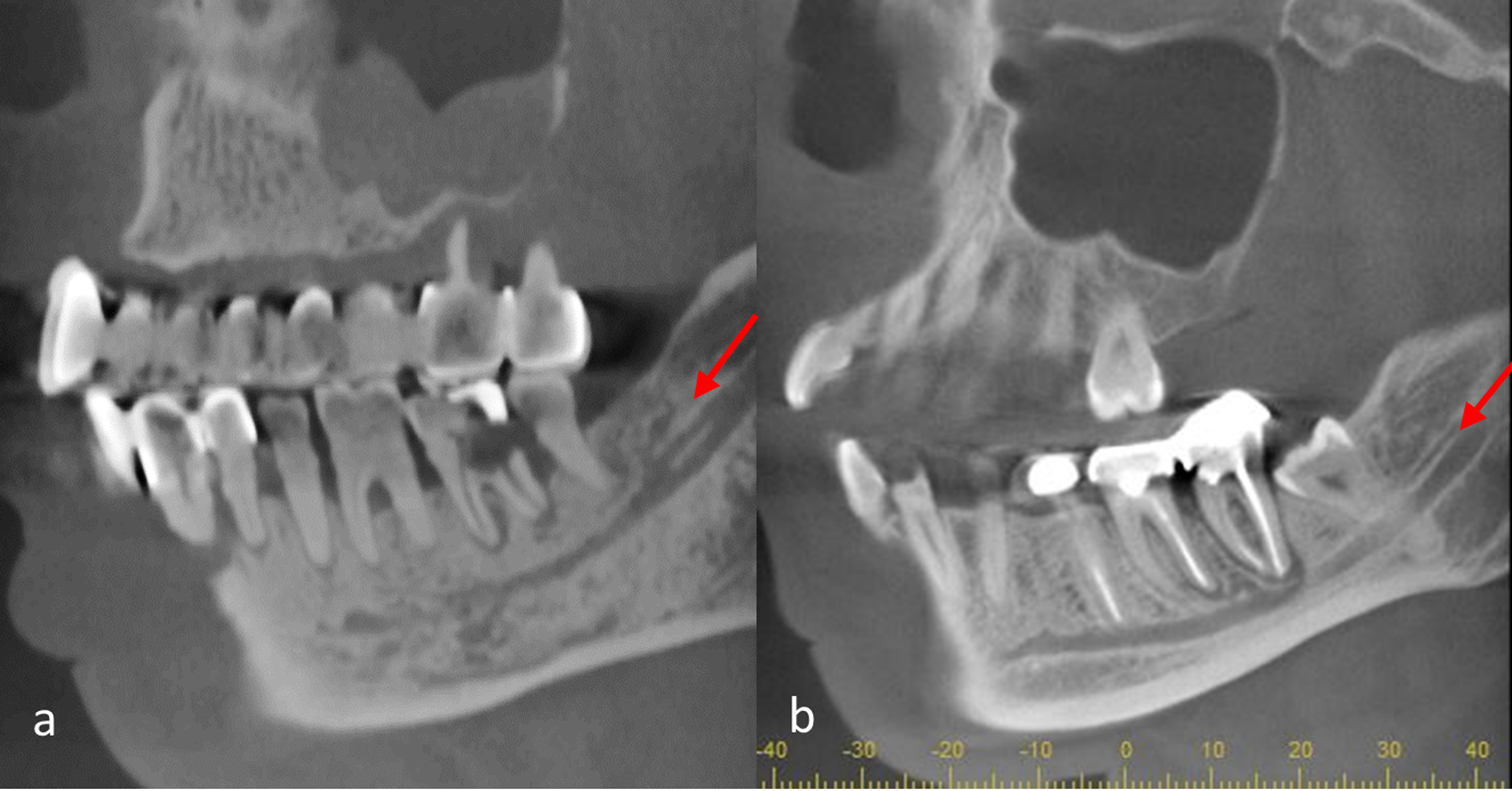 Pattern diversity and prevalence of bifid mandibular canal: a CBCT-based cross-sectional study