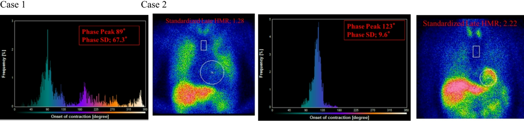 Clinical effect of three-dimensional left ventricular mechanical dyssynchrony and cardiac sympathetic denervation in systolic heart failure risk-stratified by left ventricular ejection fraction and QRS duration