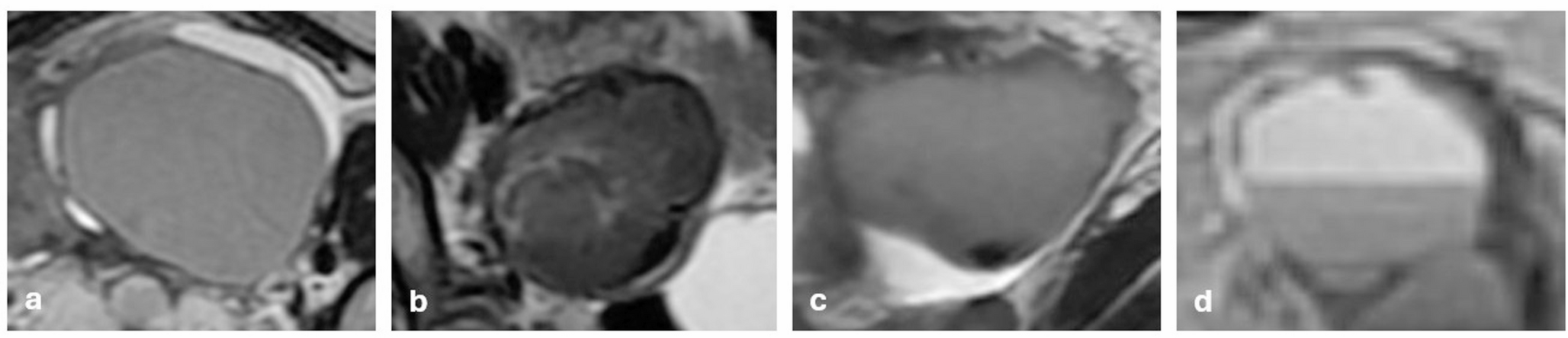 A review of the MRI features of endometriosis: what should be paid attention to during the reporting process?