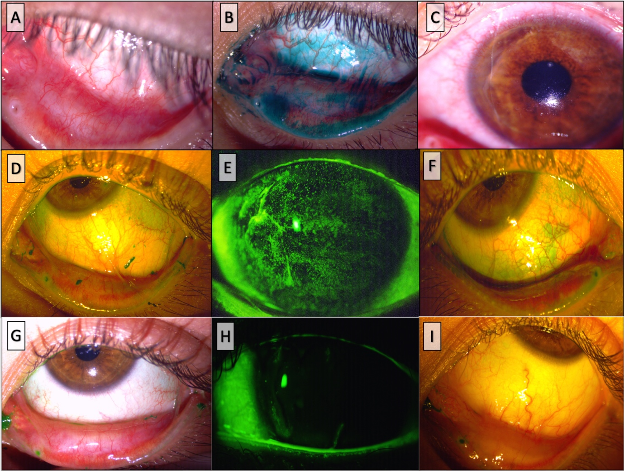 Childhood-onset ocular mucous membrane pemphigoid presenting with peripheral ulcerative keratitis: a case report and review of the literature