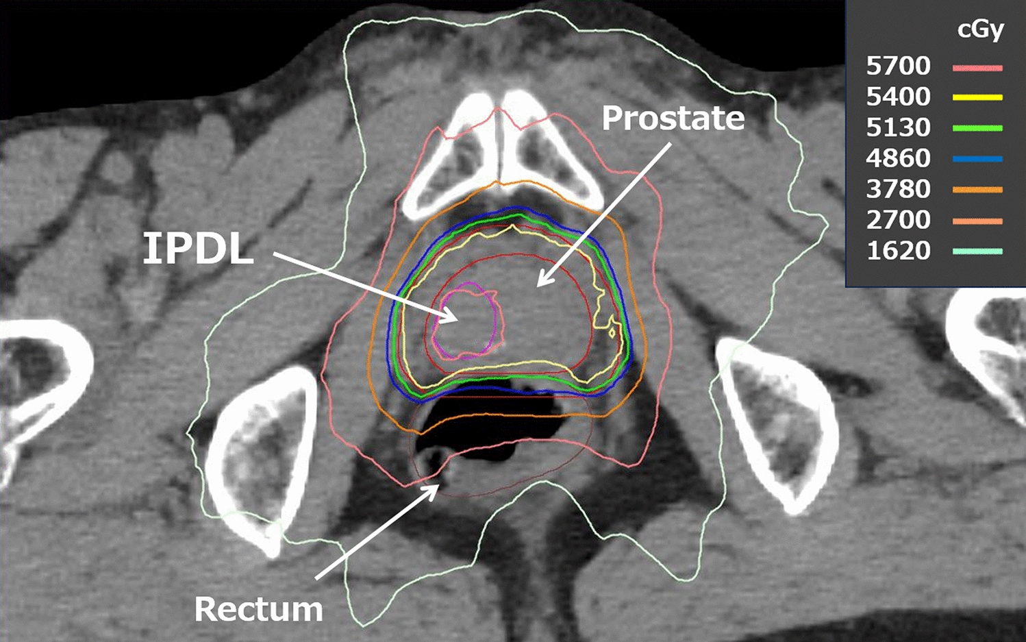 Narrative review of focal boost to intraprostatic dominant lesion in intensity-modulated radiation therapy for localized or locally advanced prostate cancer