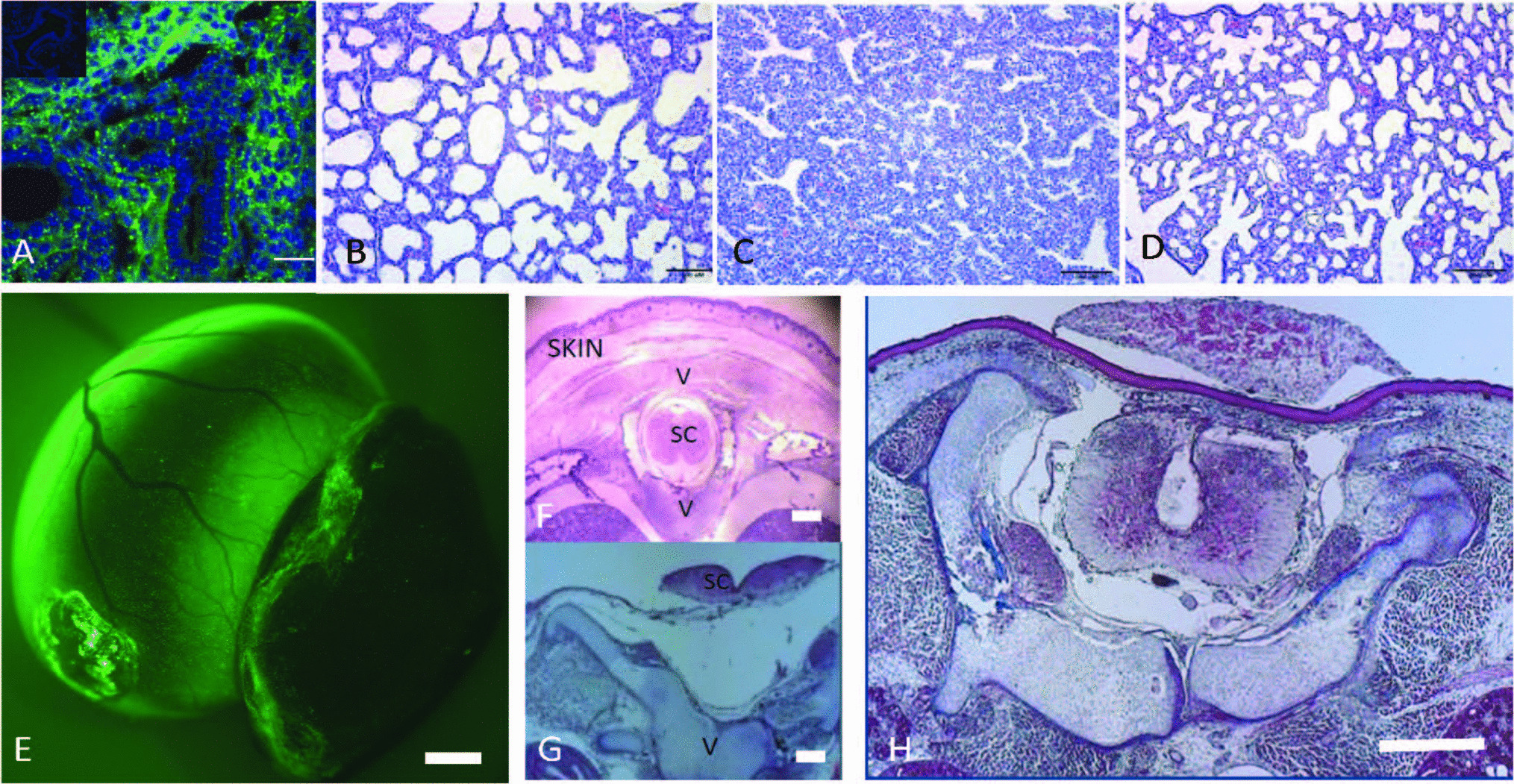 Prenatal Therapy for Congenital Diaphragmatic Hernia and Myelomeningocele: Advances in Particle-Based Delivery