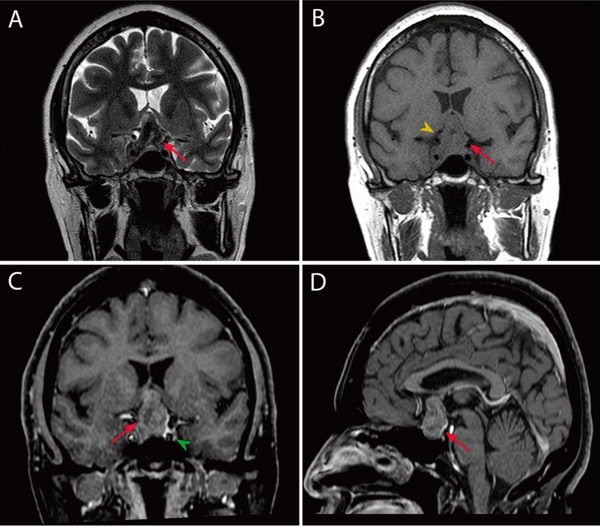 Triple sellar collision lesion: a unique case of pituitary adenoma, Rathke cleft cyst, and xanthogranuloma—case report and systematic review of the literature
