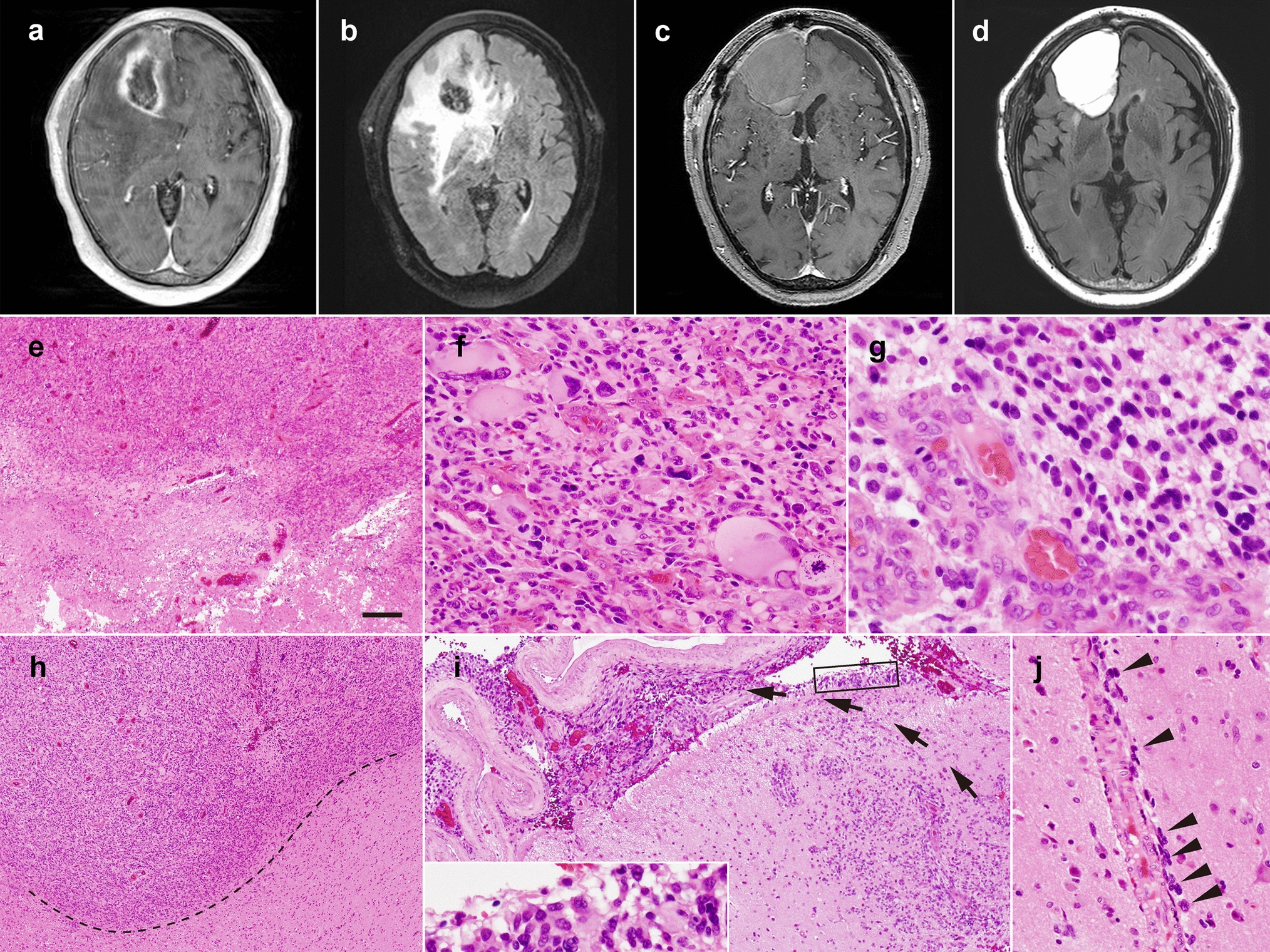 Rapidly progressive scalp and lung metastases with fatal pneumothorax in glioblastoma, IDH-wildtype, with  and  amplifications: a case report of clinical course and postmortem autopsy, including genetic analysis