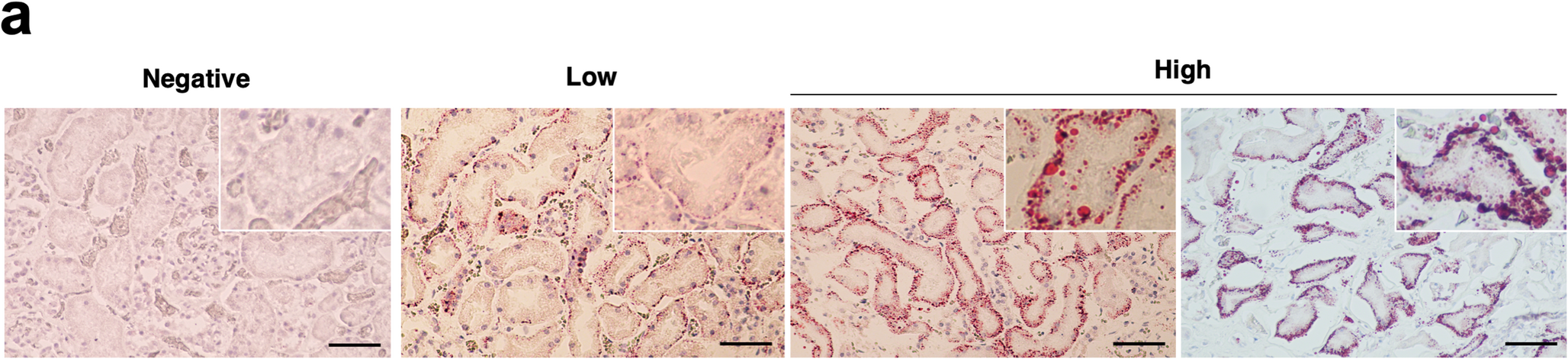 Hypothermia drives fatty acid transporter 1 upregulation and lipid accumulation in renal tubules: evidence from forensic cases