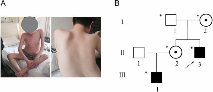 Pseudoexon activating by a deep intronic variant and phenotype variation in a Chinese family with dystrophinopathy