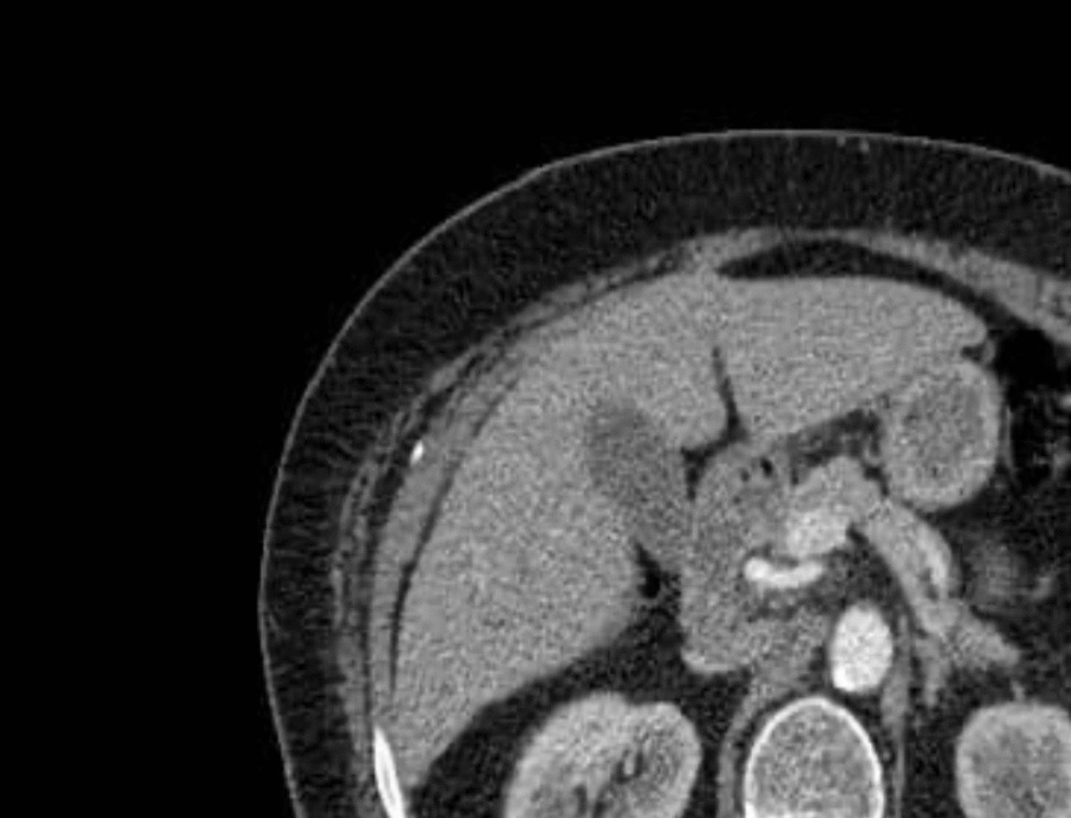 Insulinoma in a patient with type 2 diabetes:  A case report