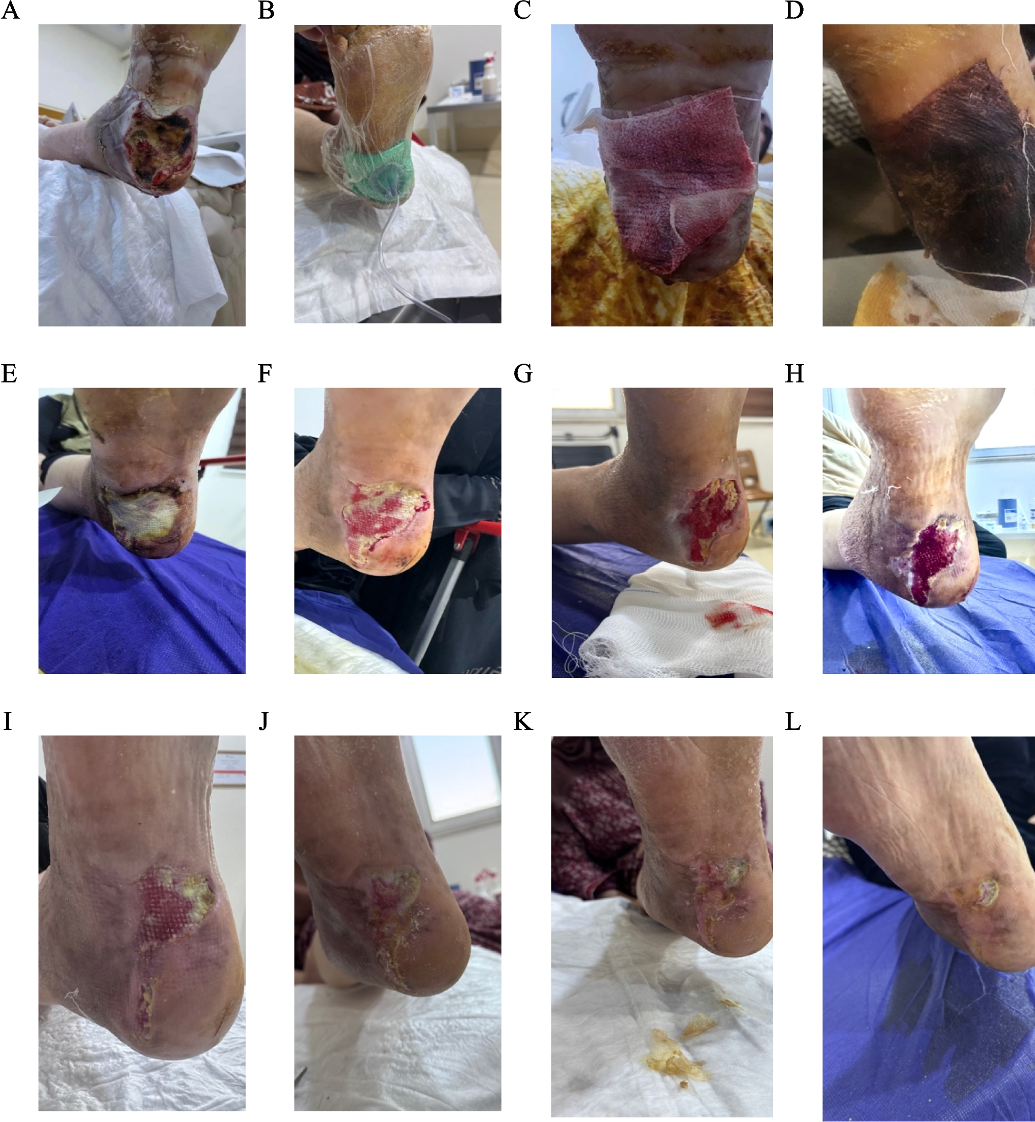 Surgical debridement and application of ovine forestomach matrix in diabetic foot ulcer:  A case report