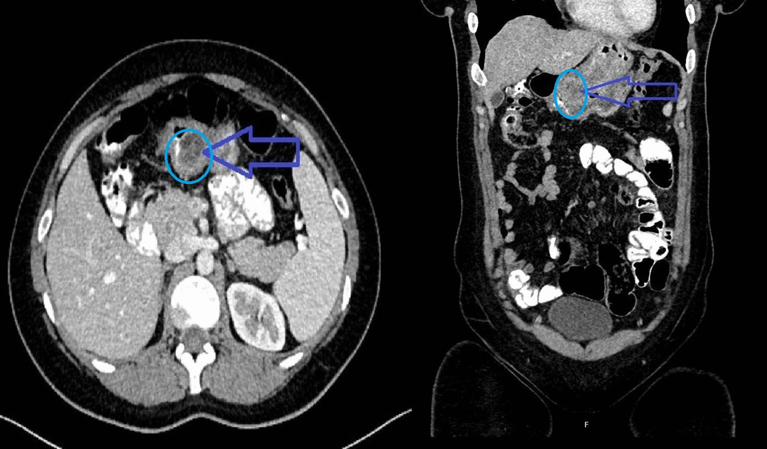 Management of Refractory Gastric Ulcer and Hemorrhage After Gastric Plication: A Case Report of a Rare Complication
