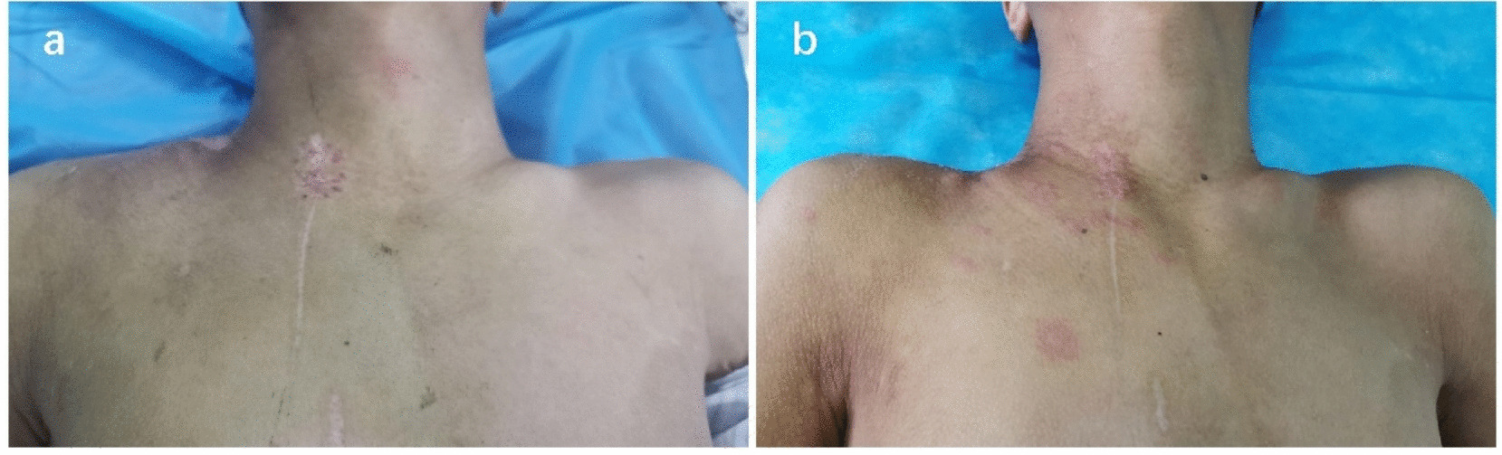 Giant Cervical Pseudomeningocele Following Traumatic Brachial Plexus Traction Injury: A Case Report