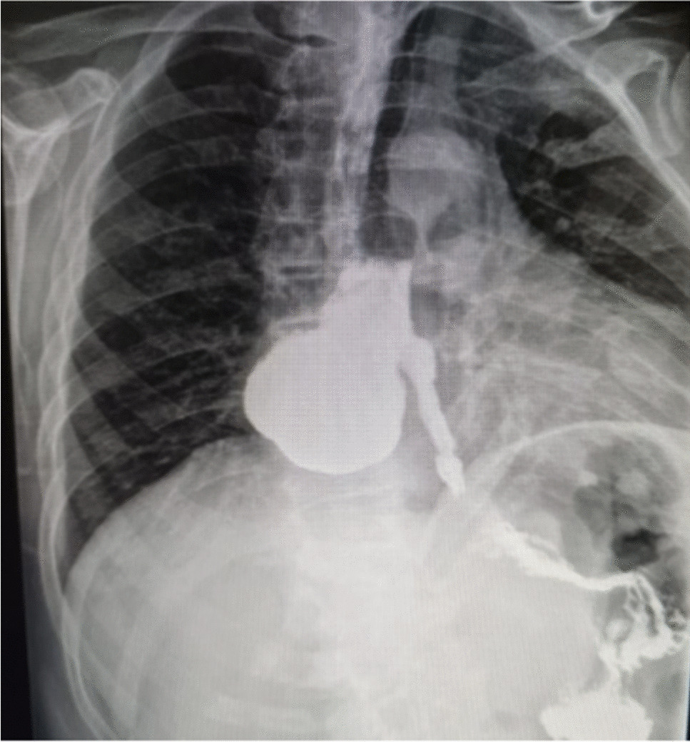 How to do a Thoracoscopic-Laparoscopic Surgery for a Middle Thoracic Esophageal Diverticulum with Underlying Achalasia