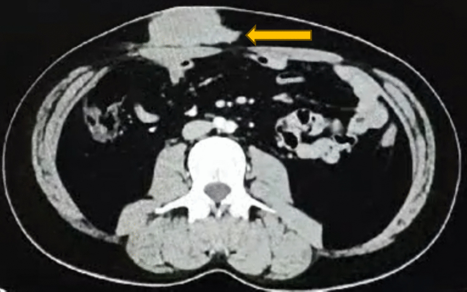 Primary Cutaneous Rosai Dorfman Disease- The Great Mimic