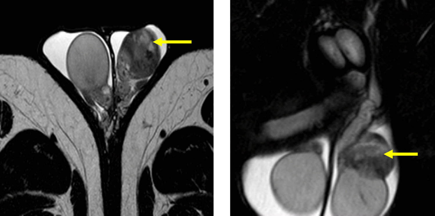 Adenomatoid Tumor of the Epididymis - A Rare Case Report
