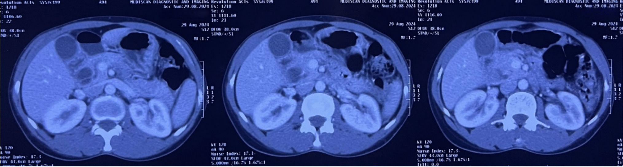 Novel Procedure for Benign Ampullary Tumors: “Retrograde Ampullectomy with Extraduodenal Approach”—A Case Report