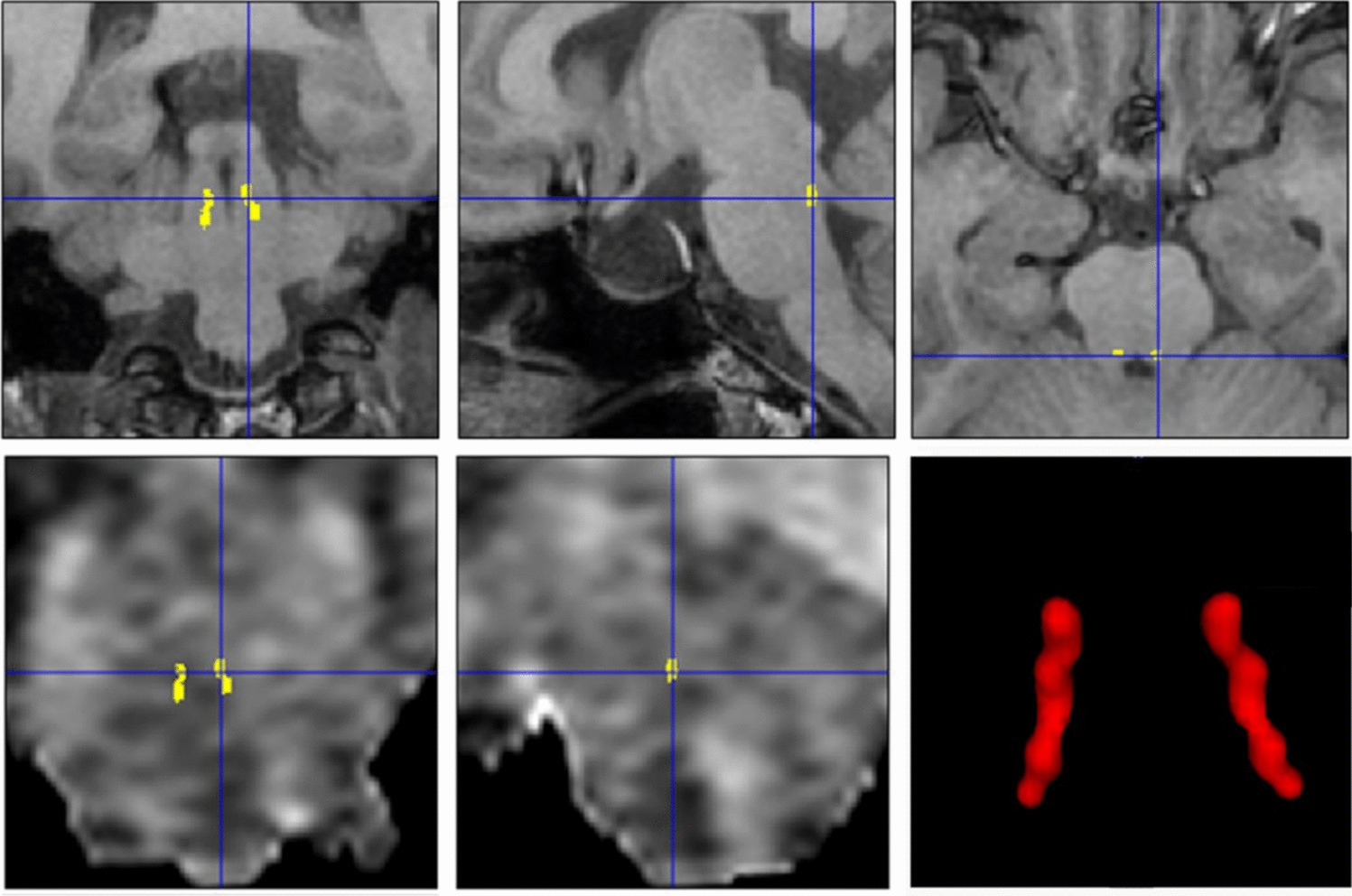 Altered perfusion in the locus coeruleus of patients with chronic migraine: a pilot 3D-PCASL study