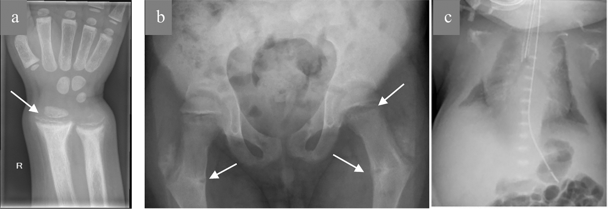 Differential diagnosis of heritable and acquired osteomalacia in children: biochemical and biomaterial signatures