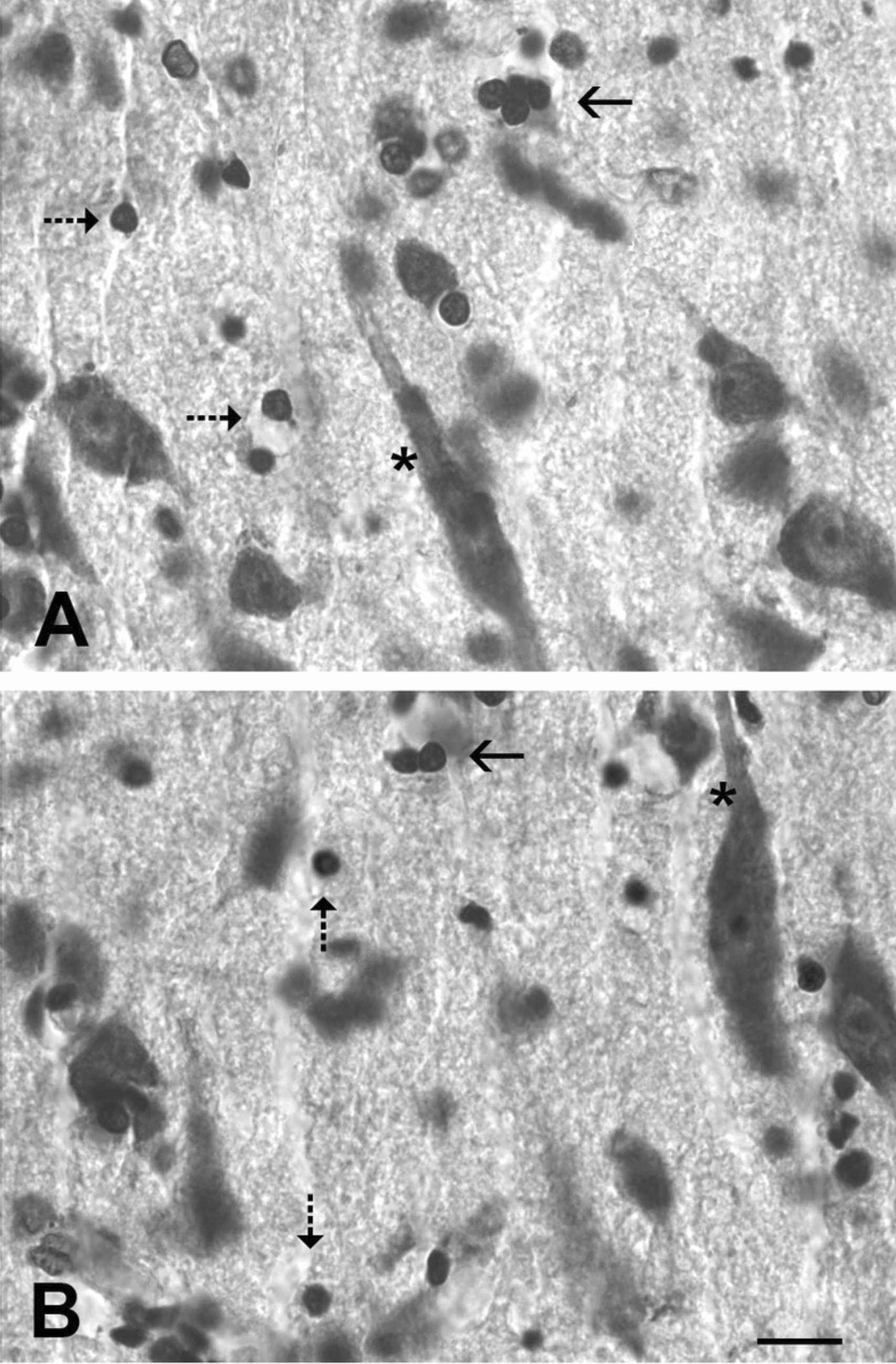 Deficit of oligodendrocyte family cells in layer 5 of the dorsal anterior cingulate cortex in schizophrenia
