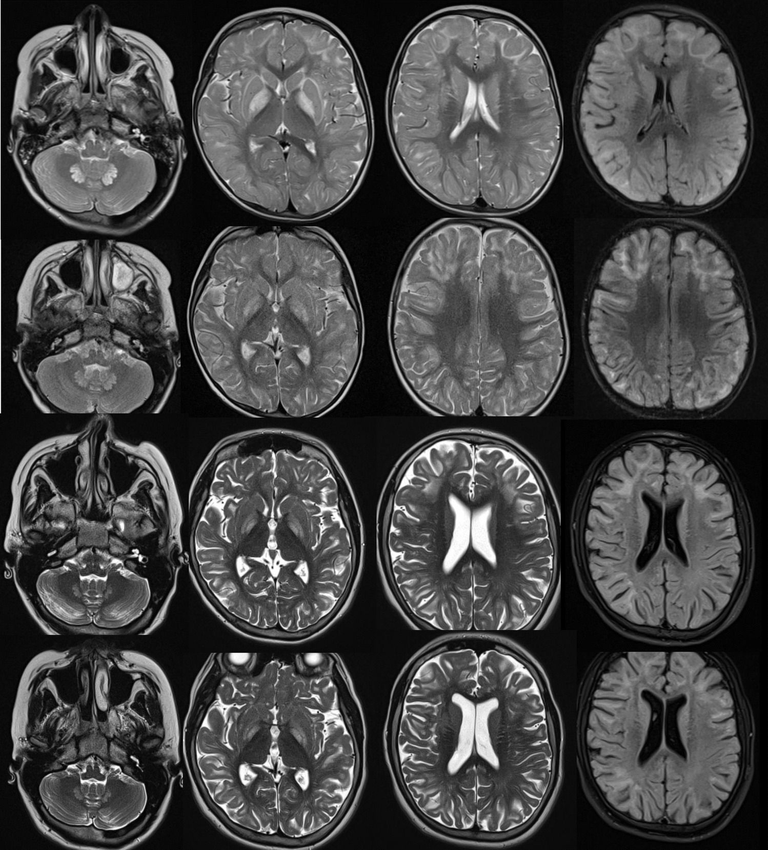 Riboflavin treatment in L-2-hydroxyglutaric aciduria: report on a pediatric patient and literature review
