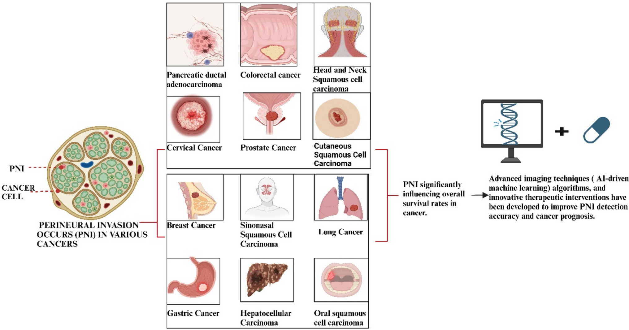 Unraveling the role of perineural invasion in cancer progression across multiple tumor types