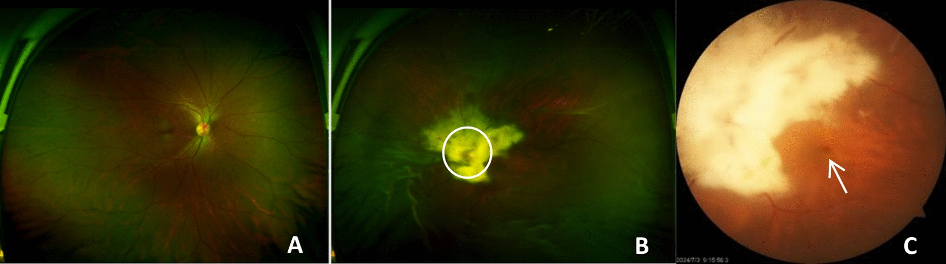 A case of extensive myelinated retinal nerve fibers combined with macular hole retinal detachment
