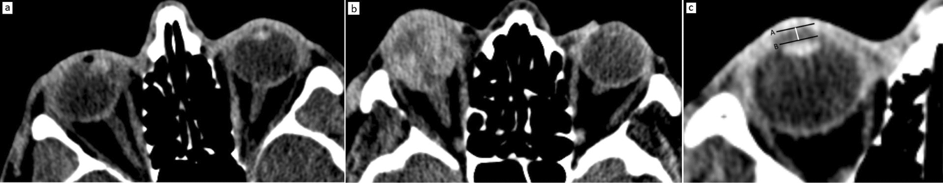 Diagnostic value of computed tomography in predicting open globe injury