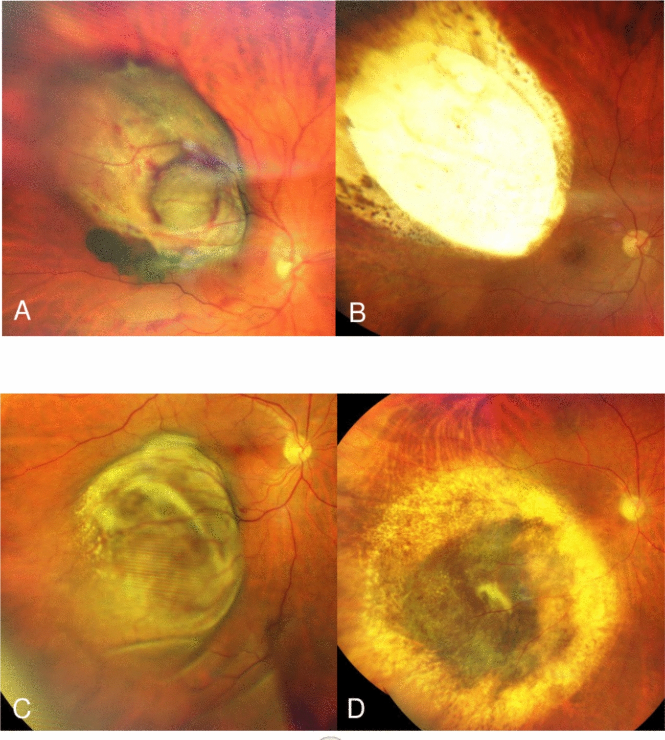 Long-term outcome after treatment of large uveal melanoma