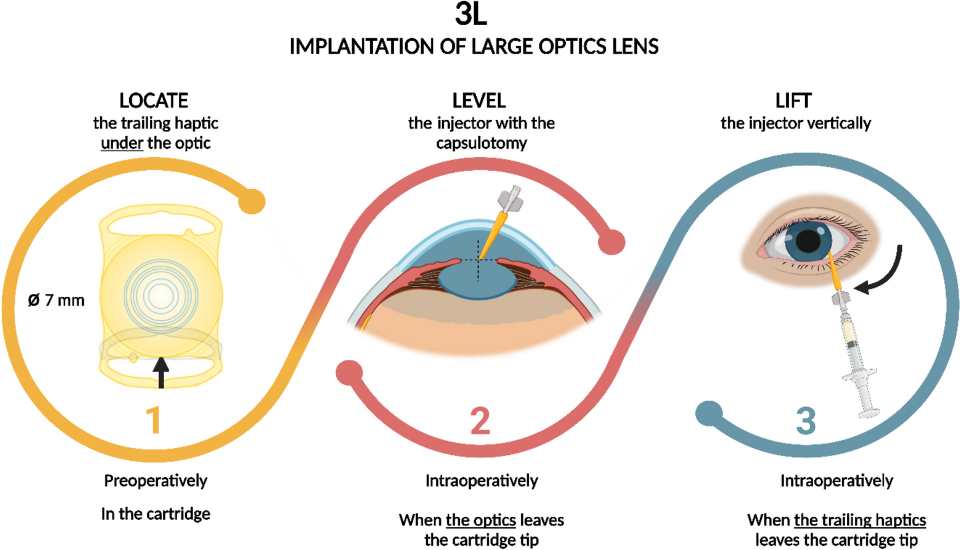 Three-step technique for easy implantation of large optic IOLs