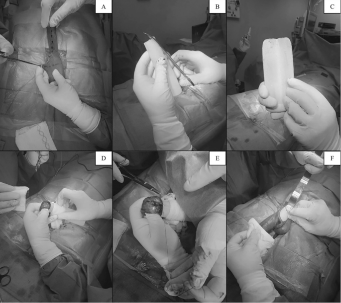 Silicone penile prosthesis without suprapubic lipectomy for buried penis: a pilot study on the efficacy of HimplantTM