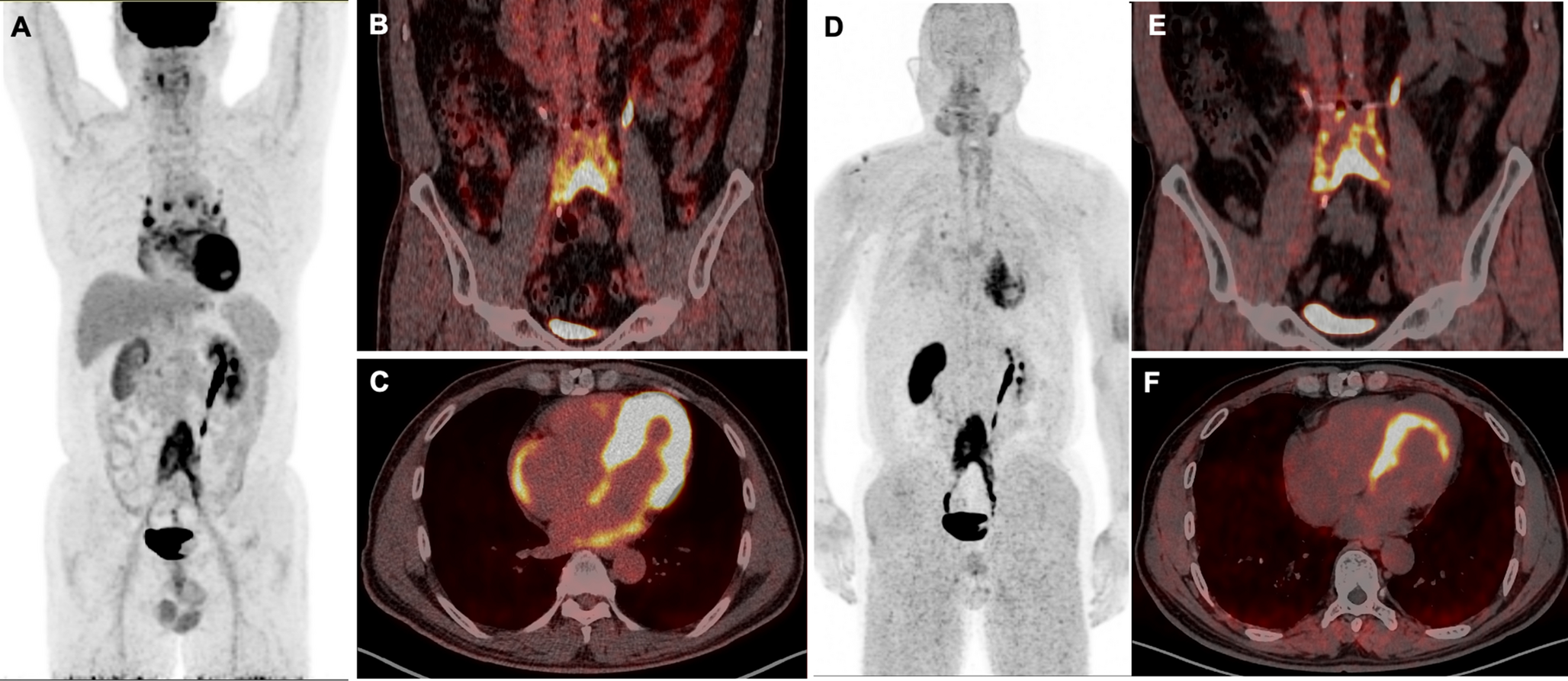 Incidental myocardial uptake of Ga-FAPI-04 caused by hypertrophic cardiomyopathy in a patient with Immunoglobulin G4-related disease