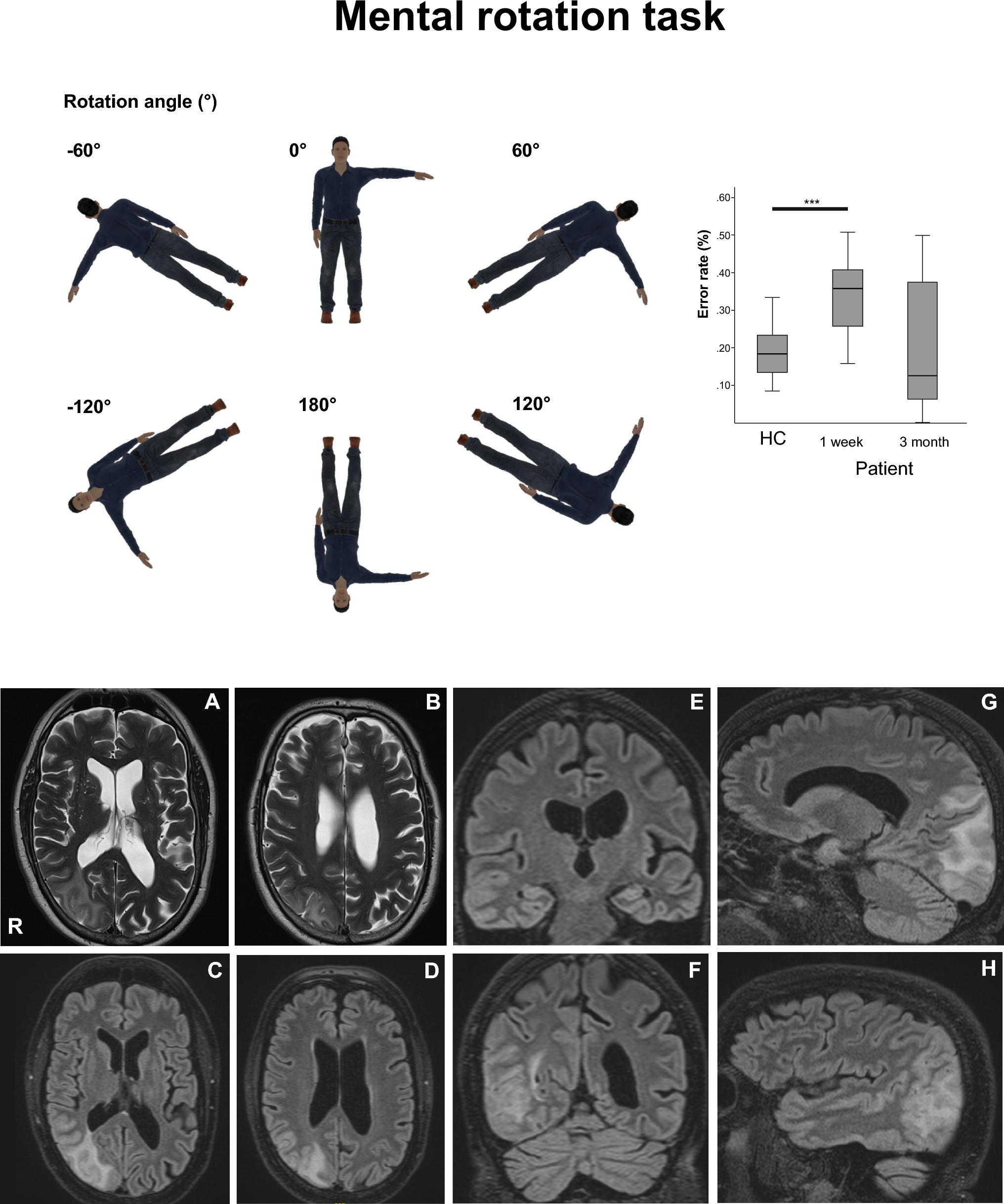 Object but no room tilt illusion due to apperceptive visual agnosia in a right parieto-occipital lesion disconnecting visual–spatial integration