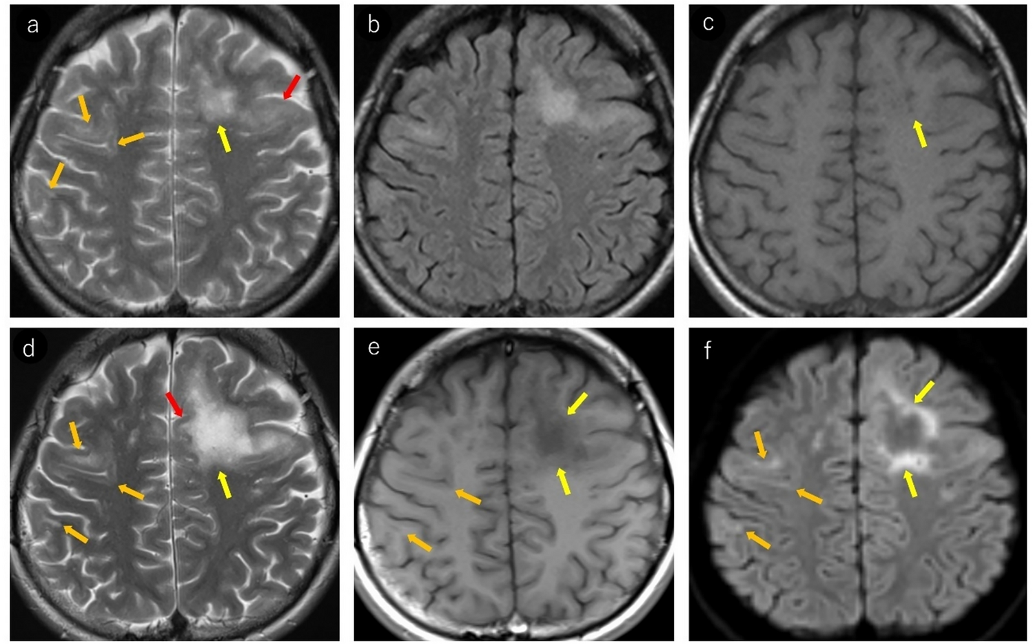 Overview of MRI findings in progressive multifocal leukoencephalopathy