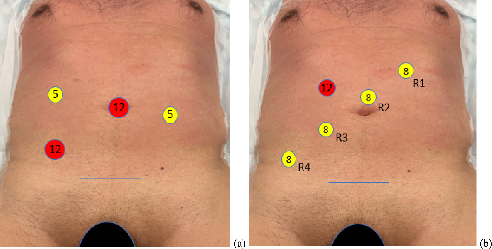 Robotic versus laparoscopic anterior resection: comparative short-term outcomes in a propensity score matched cohort