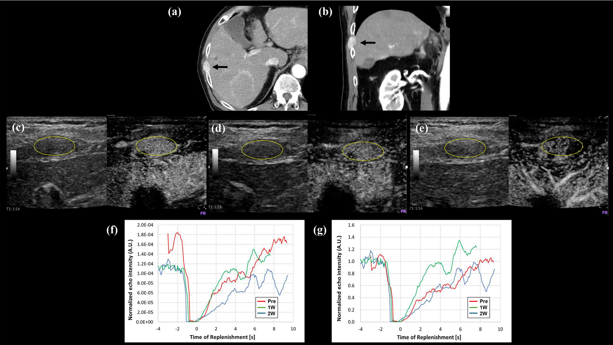 Sonographic evaluation of vascular normalization induced by lenvatinib in a patient with hepatocellular carcinoma