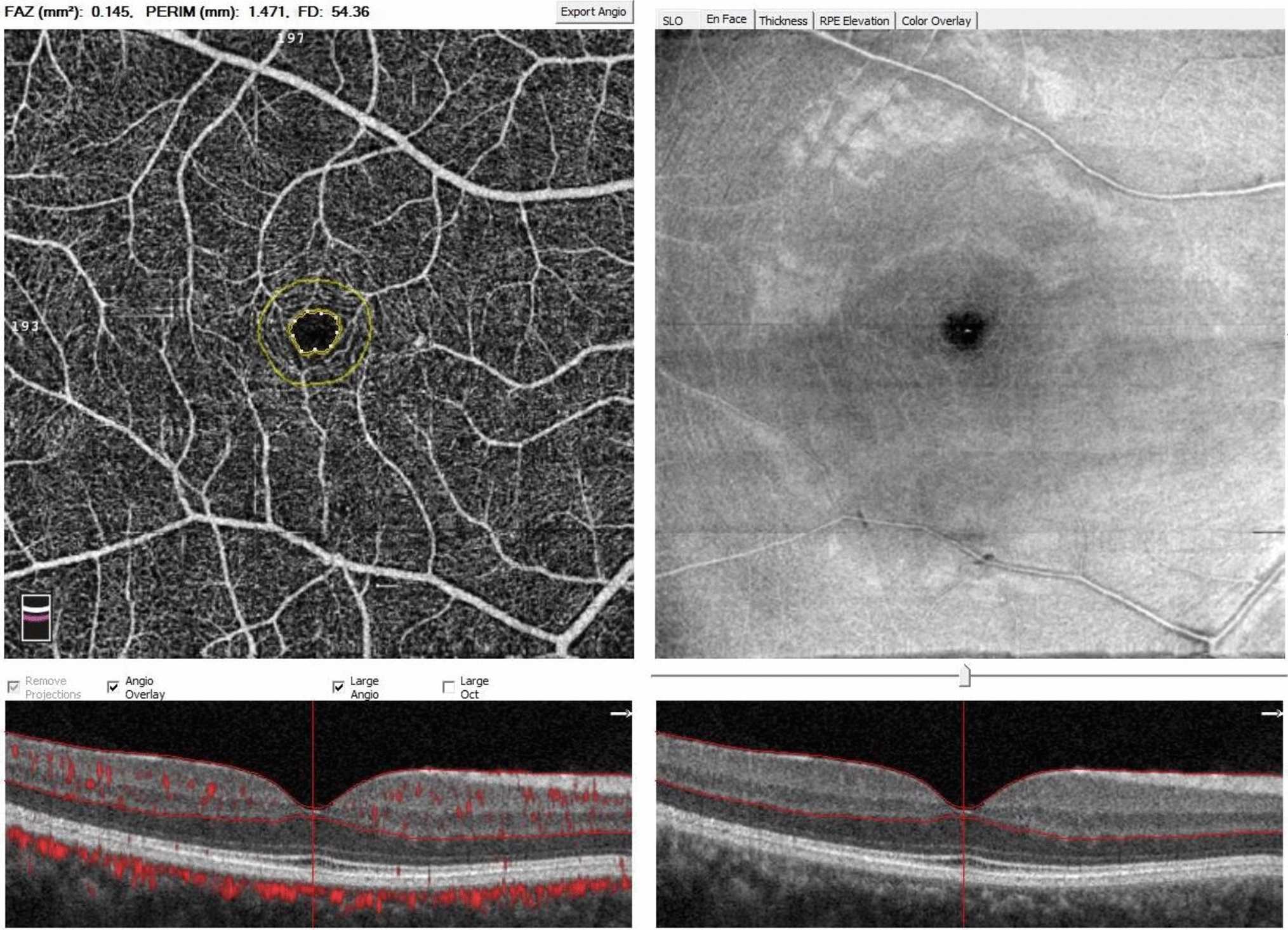 Vascular characteristics of pediatric patients with familial Mediterranean fever: a study of optical coherence tomography angiography findings