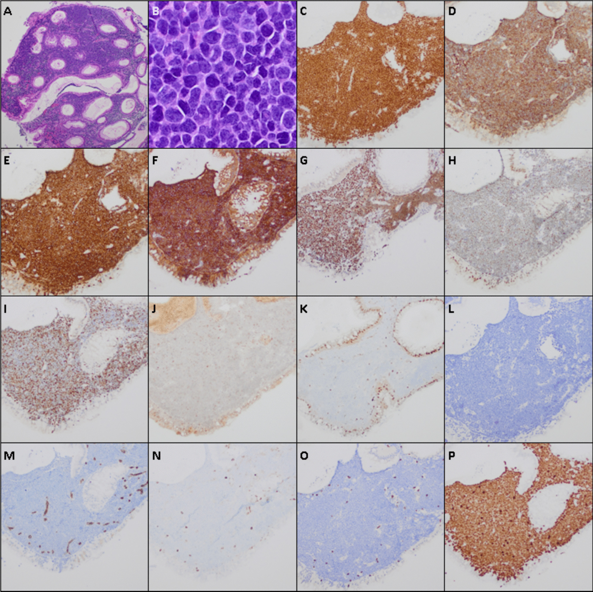 CD5-positive B-cell acute lymphoblastic leukemia/lymphoma with  mimicking aggressive mature B-cell lymphoma: a case report of a newly described entity and potential diagnostic pitfall