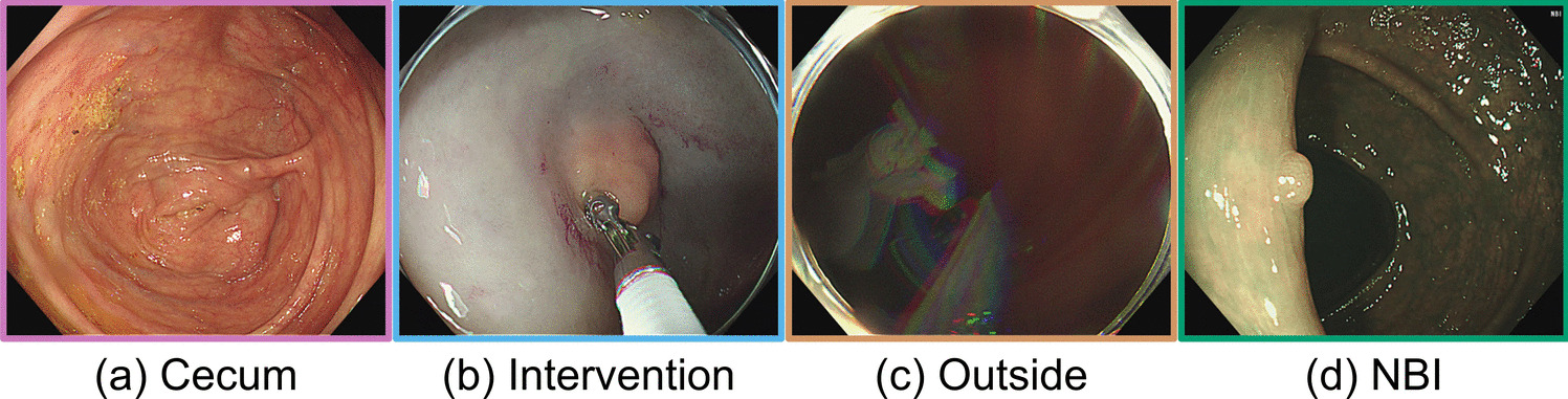 Evaluation of Net Withdrawal Time and Colonoscopy Video Summarization Using Deep Learning Based Automated Temporal Video Segmentation