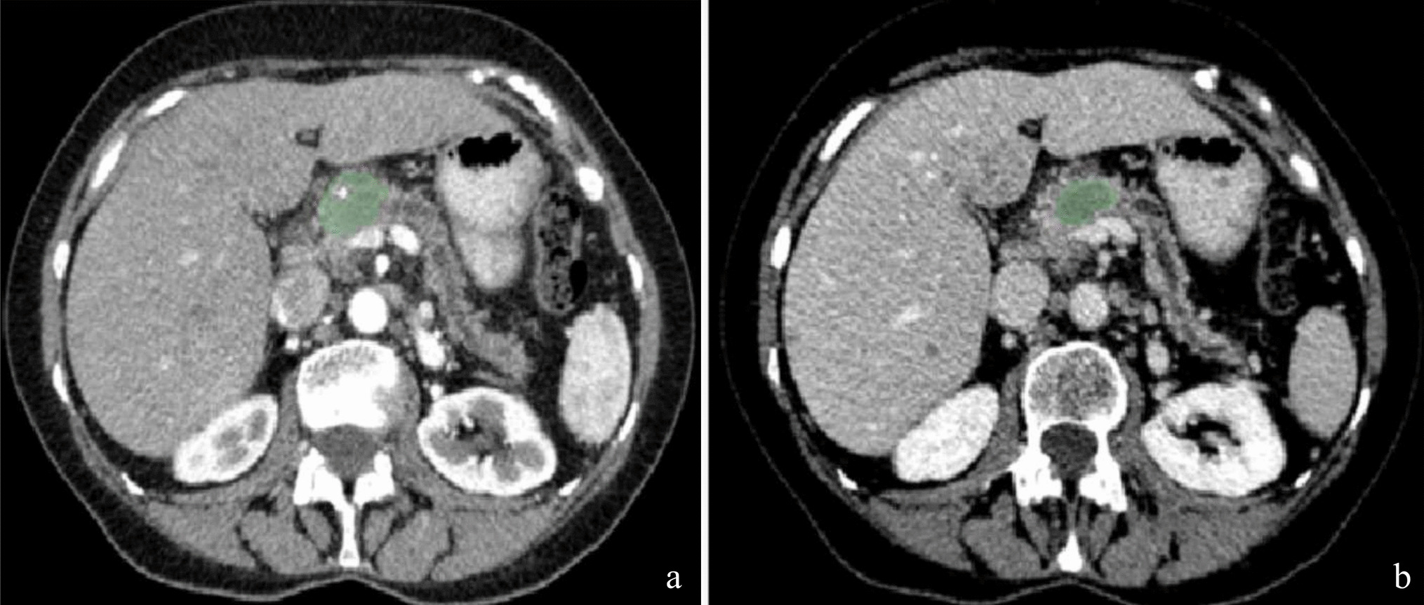 Can Machine Learning Predict Metastatic Sites in Pancreatic Ductal Adenocarcinoma? A Radiomic Analysis