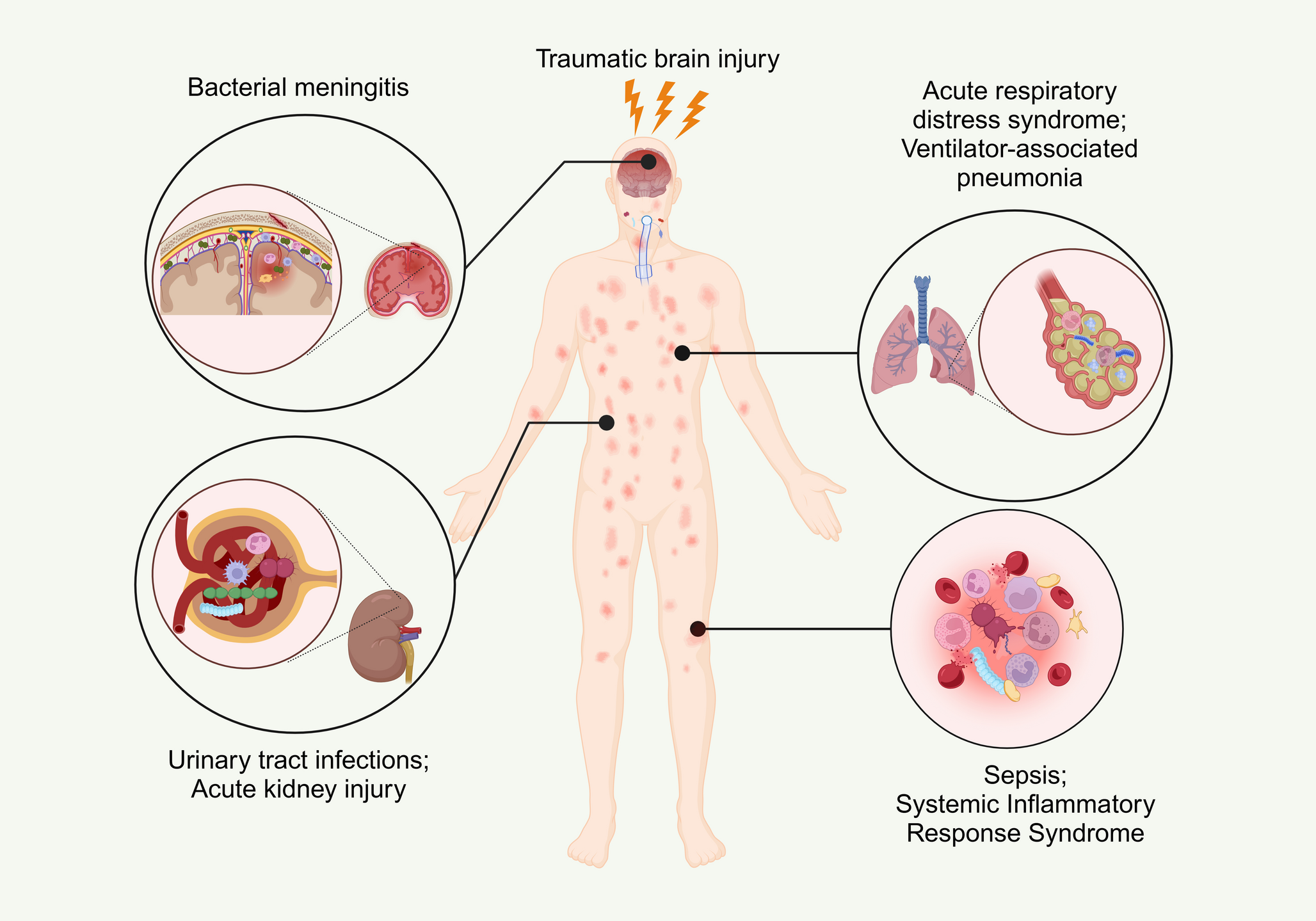 Association between traumatic brain injury and risk of developing infections in the central nervous system and periphery