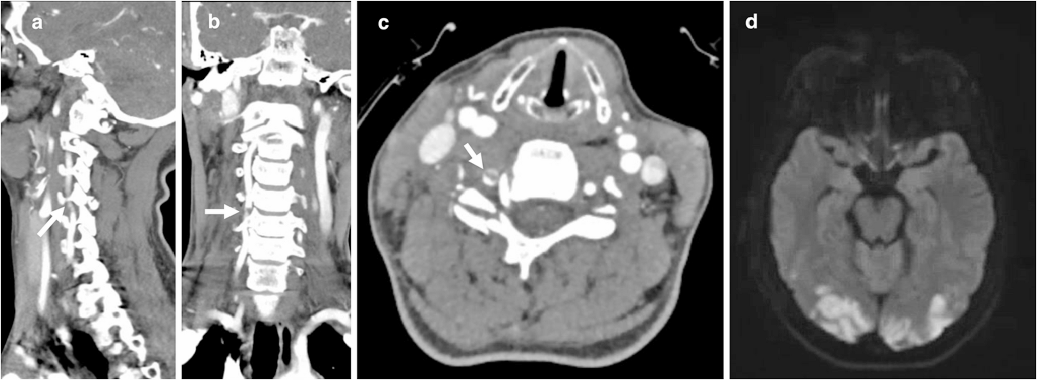 Antithrombotic therapy delays due to neurosurgical interventions after traumatic vertebral artery injuries increases stroke risk
